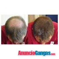 Alopecia caida del cabello