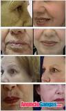 Rejuevenecimiento facial PRP