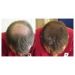 Regeneración capilar y del cuero cabelludo
